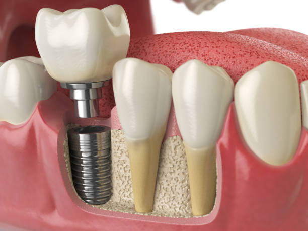 dental crowns for adults